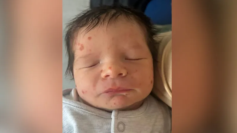 Langerhans Cell Histiocytosis in Children